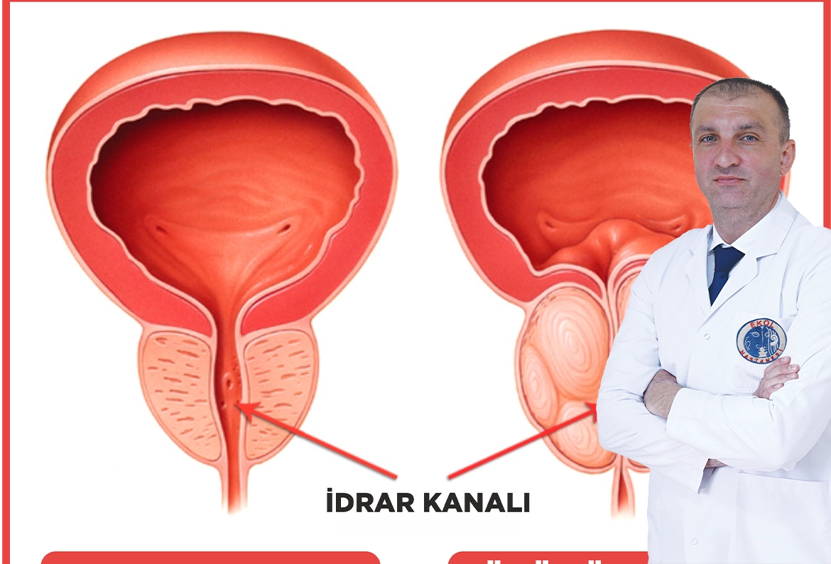 Prof. Dr. Adnan Şimşir - Genetik Yakınlık Prostat Kanserini Artırıyor