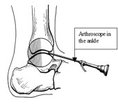 Artroskopik Ayak Bileği Ameliyatları