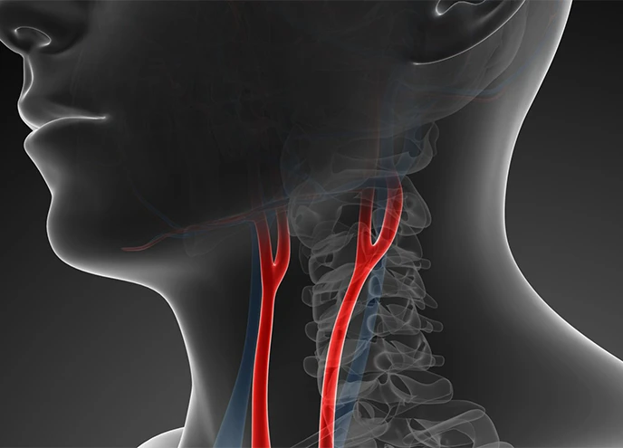 Boyun Şahdamarı (Karotis Arter) Darlıkları
