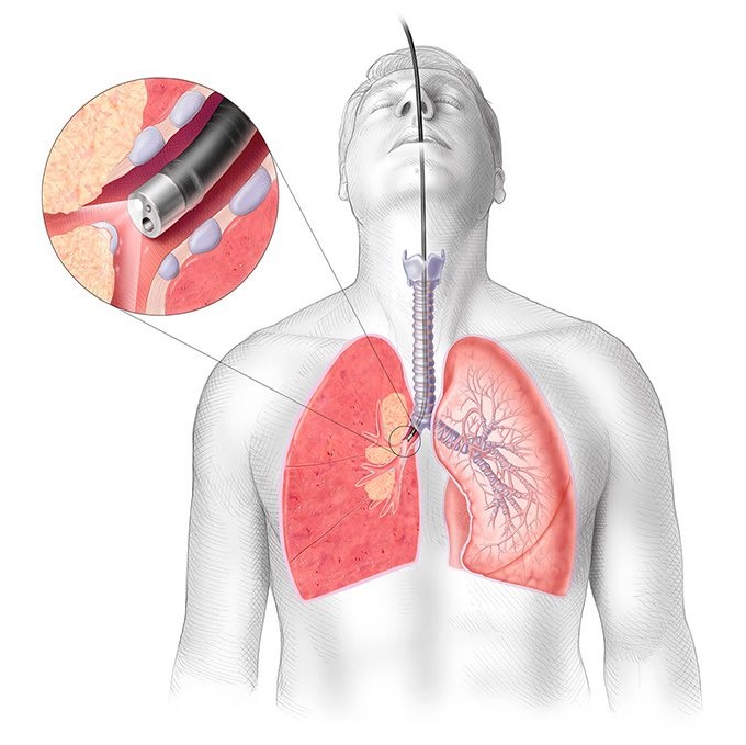 Tanısal Bronkoskopi