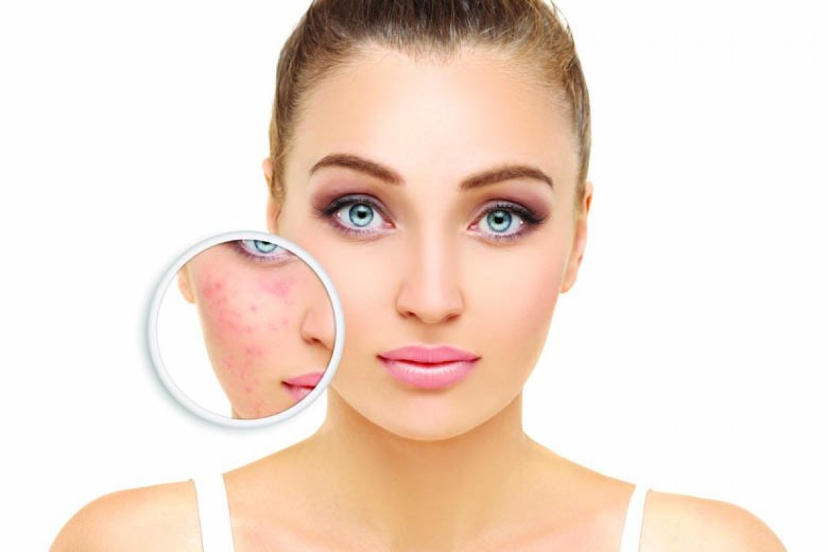 Rosacea (Gül Hastalığı)