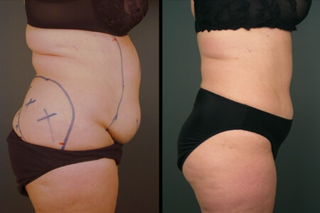 Yağ Alma (Liposuction)