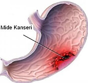 Mide Kanserleri