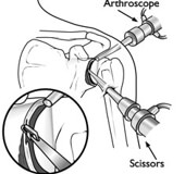 Artroskopik (Kapalı) Omuz Ameliyatları