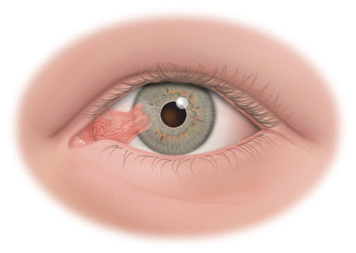 Pterygium Cerrahisi (Doku yapıştırıcılı ve greftli)