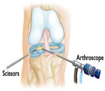 Artroskopik (Kapalı) Diz Ameliyatları