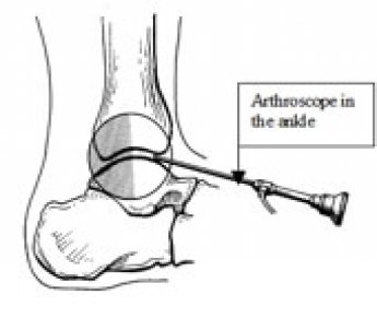 Artroskopik Ayak Bileği Ameliyatları