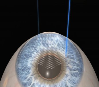 Refraktif Cerrahi (CLE, Multifokal, Trifokal, Torik Göziçi Lens implantasyonları)
