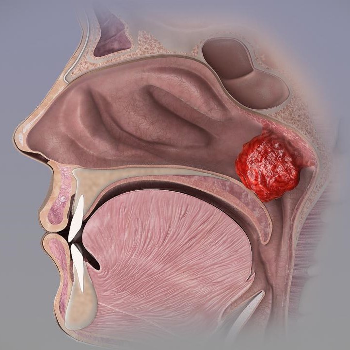 Tonsil ve Adenoid Hastalıkları